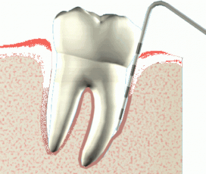 Parodontologie (parodontoza)