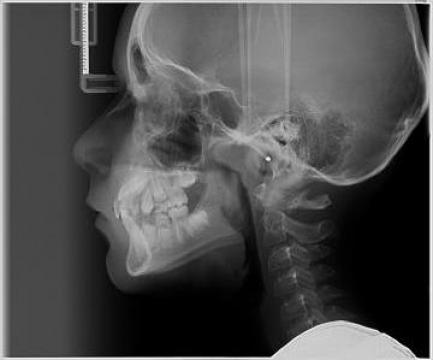 Radiografie craniu de profil (LL)