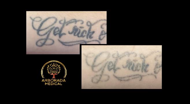 Indepartare tatuaj Oradea